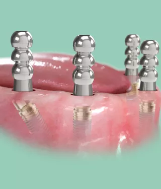 A new addition to the X-Guide digital workflow designed for full-arch cases. With FastMap, you can accurately map the final implant position and automatically register your 3D plan with the corresponding anatomy – all directly within X-Guide.