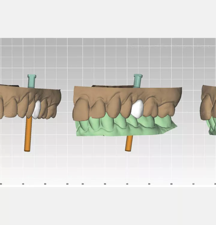 Design and planning of final dental restoration with DTX Studio Implant