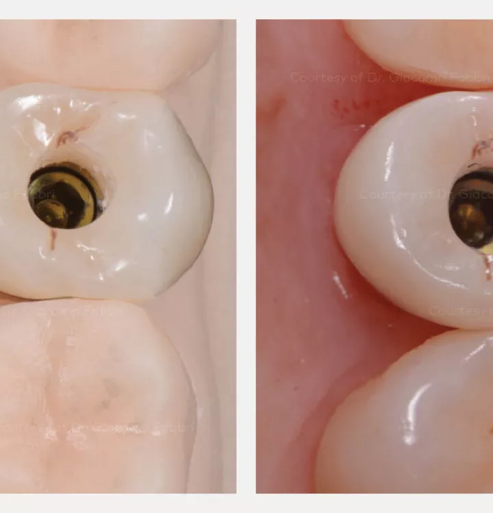 Occlusal view of the restoration on the 3D printed model and intraoral.