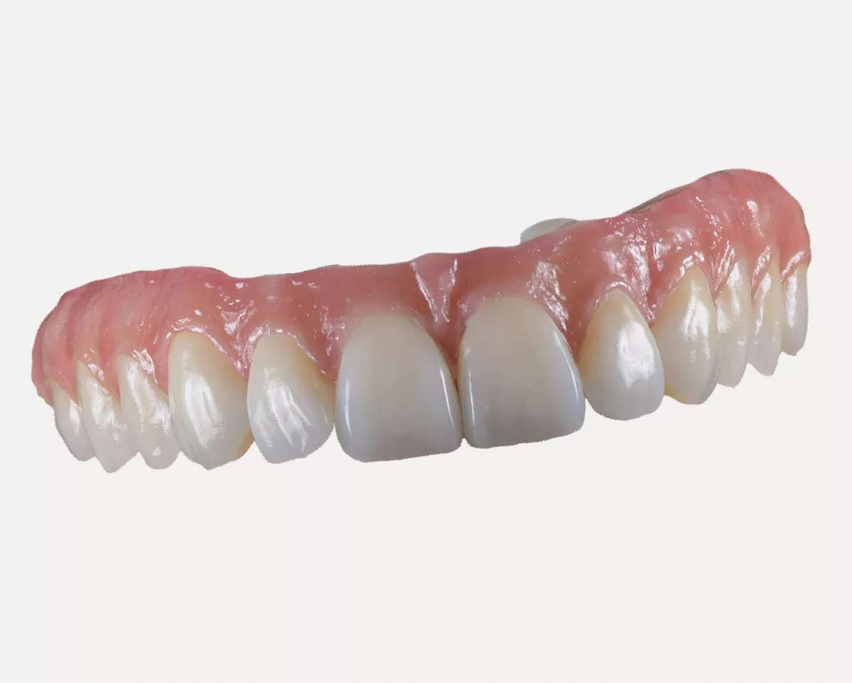 NobelProcera® Esthetic Zirconia Implant Bridge