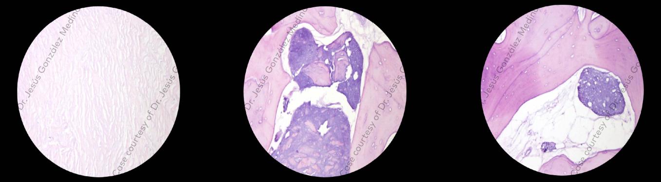 Nobel Biocare vital spongy bone tissue