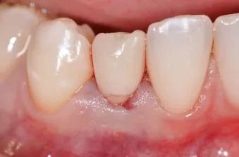 Clinical view of the cemented provisional crown which has been kept out of occlusion.