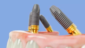 Nobel Biocare All-on-4