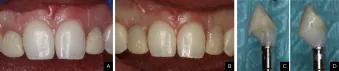 Contoured crown process from Dr. Mark Hagan case