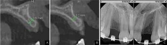 preclinical CBCT images from Dr. Mark Hagan case