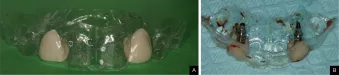 Fabricated shell crowns from Dr. Mark Hagan case