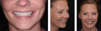 Patient's smile after delivery of provisional prostheses