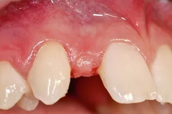 Maxillary right lateral incisor was congeniatelly missing