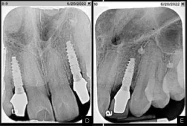 Stable peri-implant bone x-ray Dr. Mark Hagan case