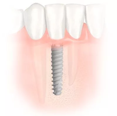 NobelActive 3.0 – a narrow space dental implant